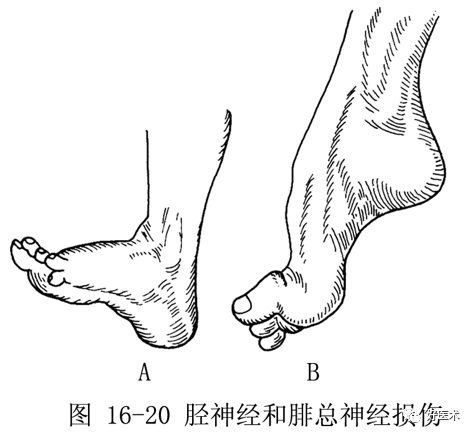 a.胫神经损伤b.腓总神经损伤您的点赞是我们进步的动力