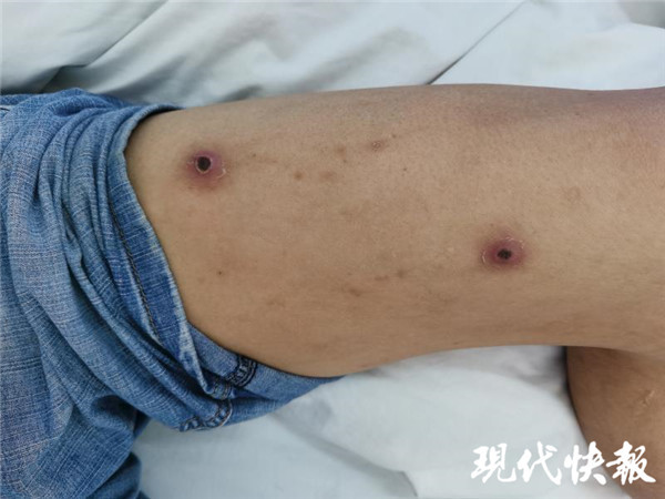 吴先生腿部有多处虫咬伤以及挠痕