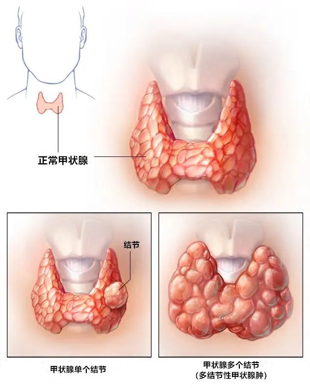 甲状腺结节切还是不切临床实战