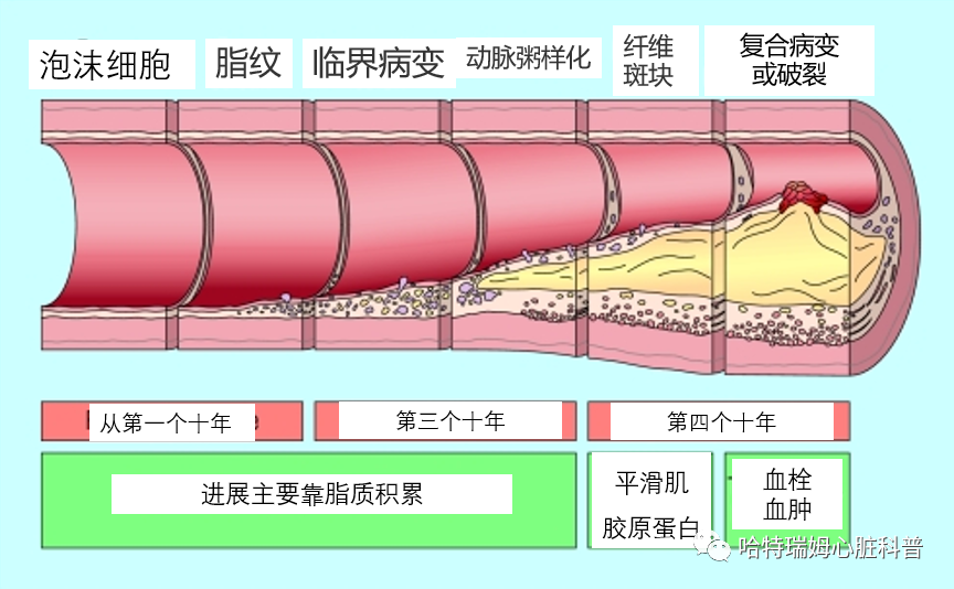 动脉粥样硬化斑块从最初的病变发展为复杂的破裂斑块