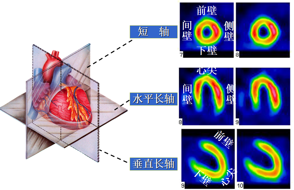 心脏的短轴,水平长轴及垂直长轴