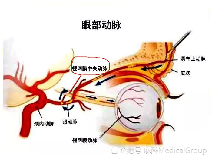 然后在上直肌的下方越至眼眶的内侧前行,终于滑车上动脉