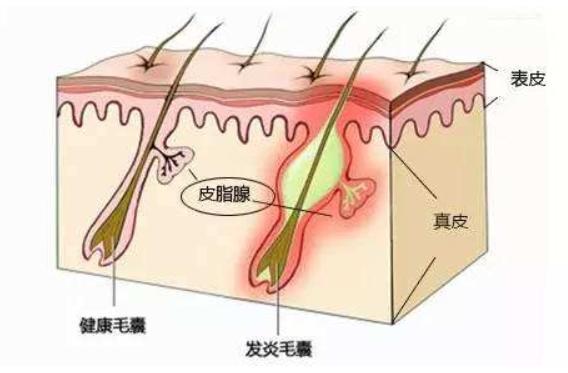 不同部位痘痘成因揭秘,长痘的你,了解真正长痘的原因