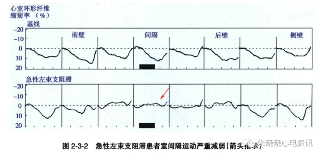 胸痛左束支阻滞综合征