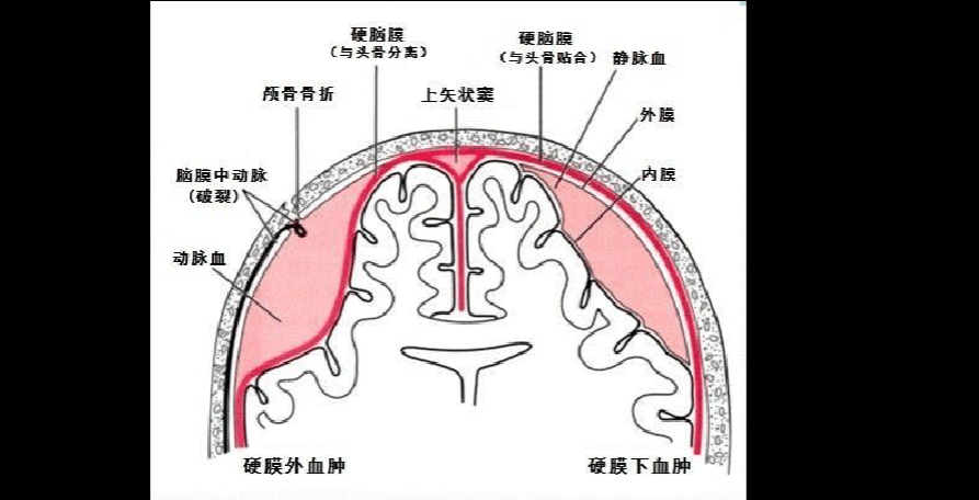 慢性硬脑膜下血肿