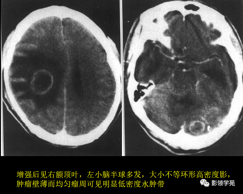 但是转移瘤位置一般表浅 (6)目前检查脑转移瘤最好的方法是增强mri