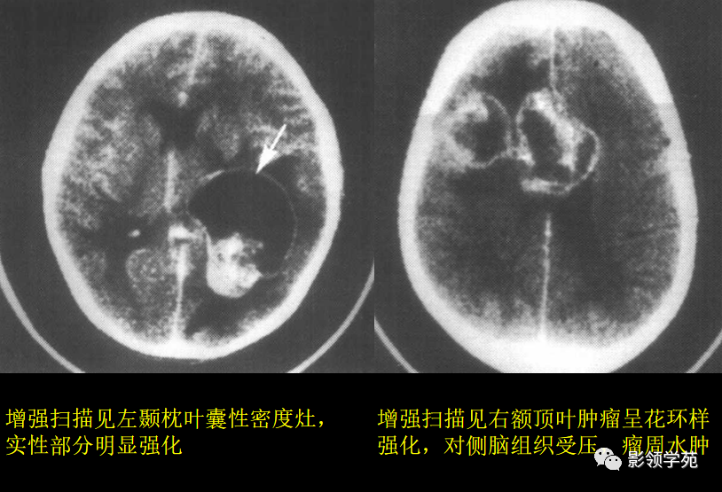 常见的颅内肿瘤的ct表现有哪些?这15种值得一看!