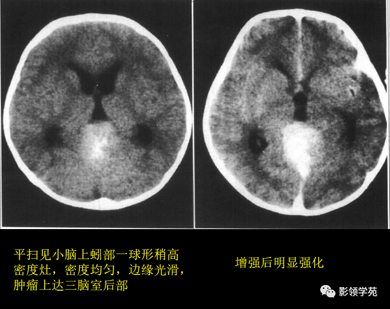 常见的颅内肿瘤的ct表现有哪些?这15种值得一看!