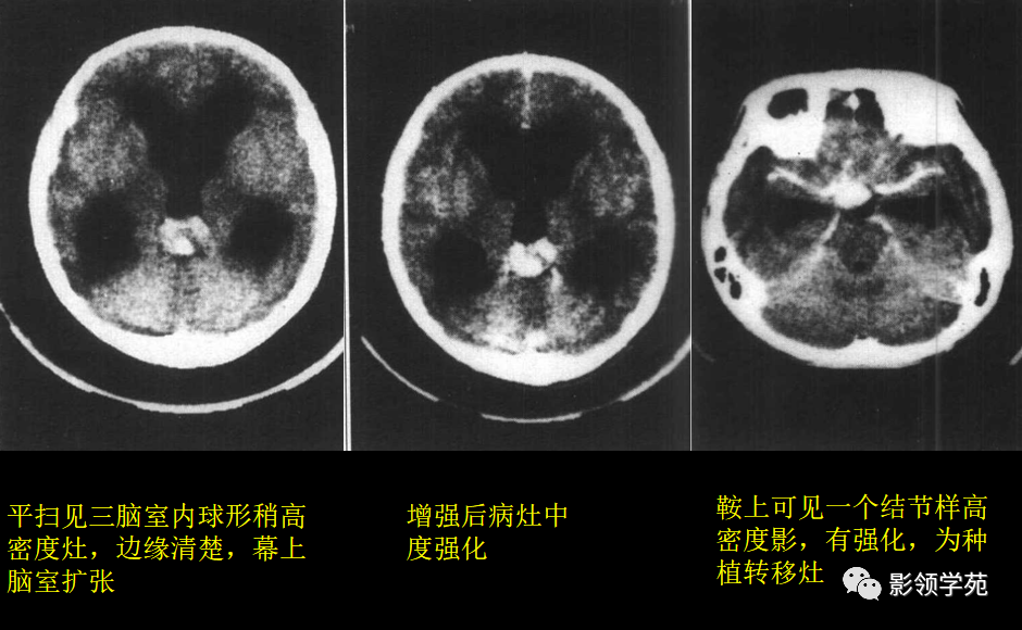 常见的颅内肿瘤的ct表现有哪些?这15种值得一看!