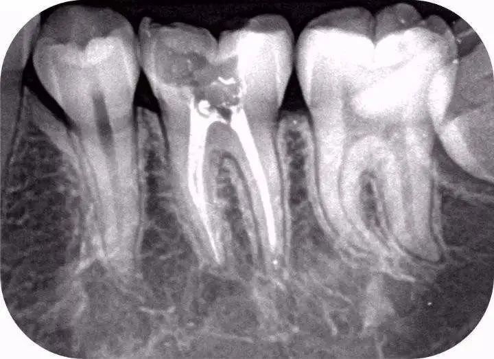 拍片之后医生才能知道牙齿本