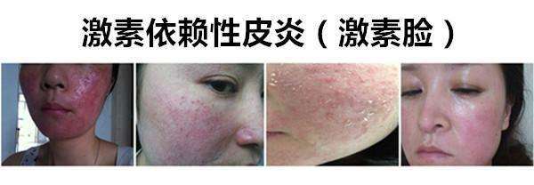 激素类药物副作用大，为什么医生还开？其实盲目拒绝更不对