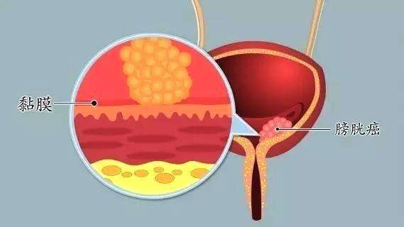 有这些症状小心膀胱癌