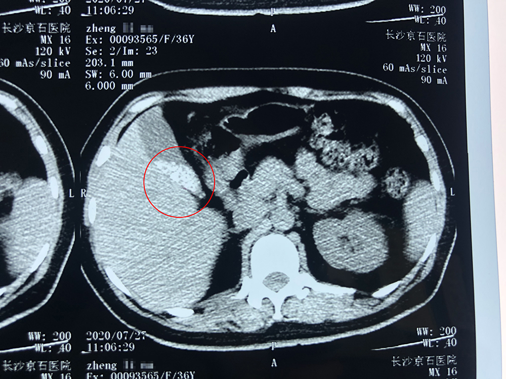 郑女士术前ct,红圈内白色部分为胆囊结石