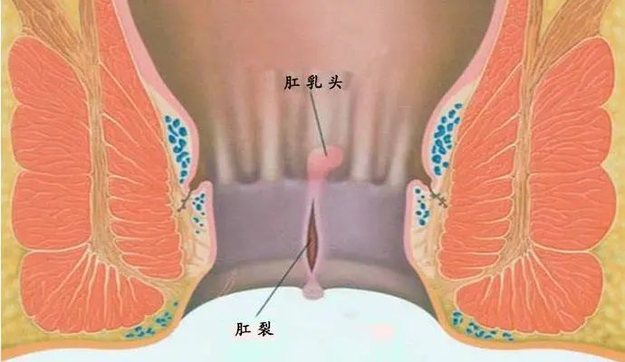 肛裂分急性肛裂和陈旧性肛裂(慢性肛裂)两种,前者可以自我缓解;后者
