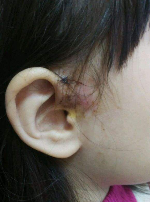 新生儿耳旁出现"小孔",绝非预示大富大贵,背后真相令人后怕
