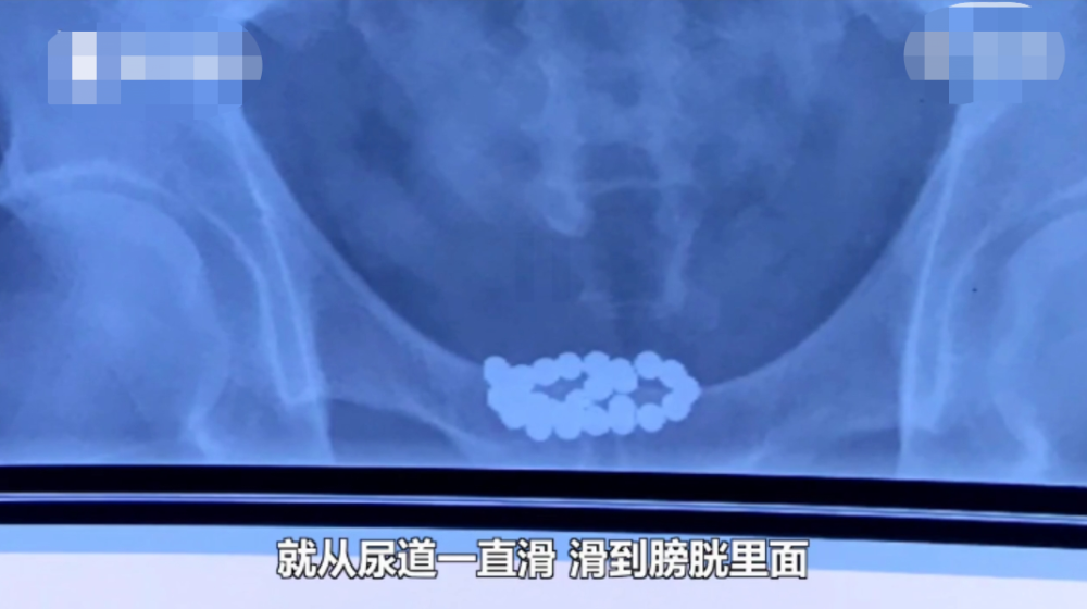 29颗磁力珠塞入尿道,男子强忍十多天后求医:表面都已钙化!