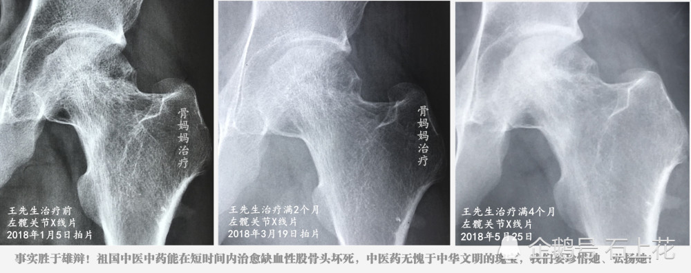 这是一个左侧股骨颈骨折术后缺血性股骨头坏死的案例,在河北当地多家