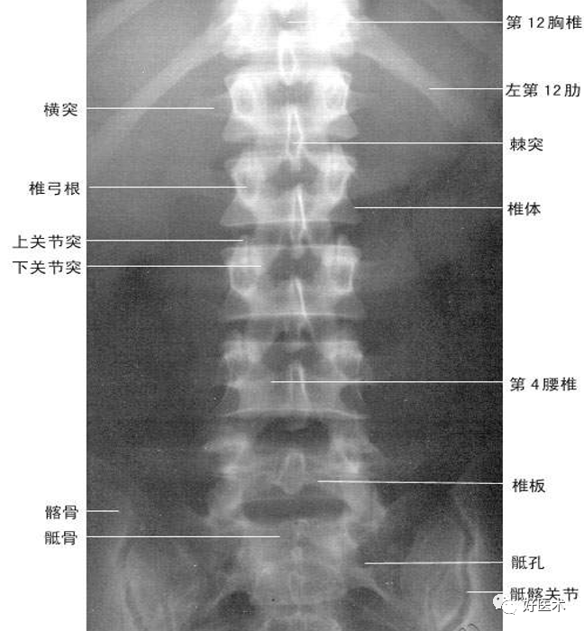 颈椎钩突:第3～7颈椎体上缘两侧斜向外上方的致密小突起,与上位椎体