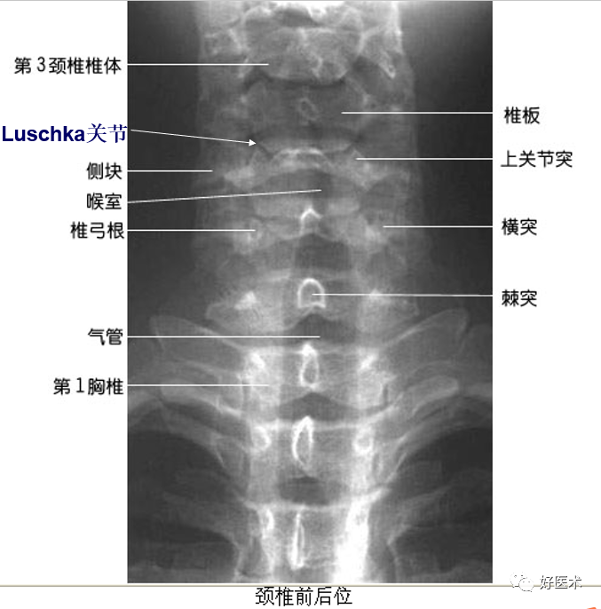 颈椎钩突:第3～7颈椎体上缘两侧斜向外上方的致密小突起,与上位椎体