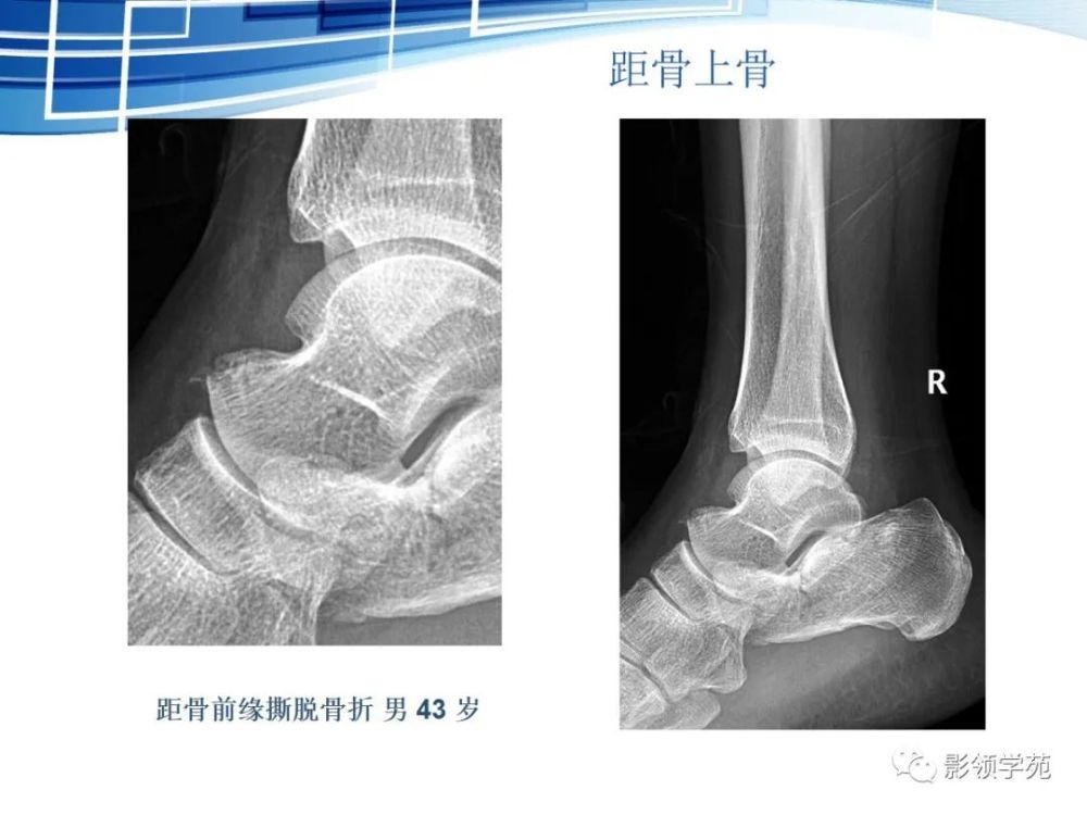 三角骨可以成对存在,还可以与外侧结节融合,形成单一的突起,并可与