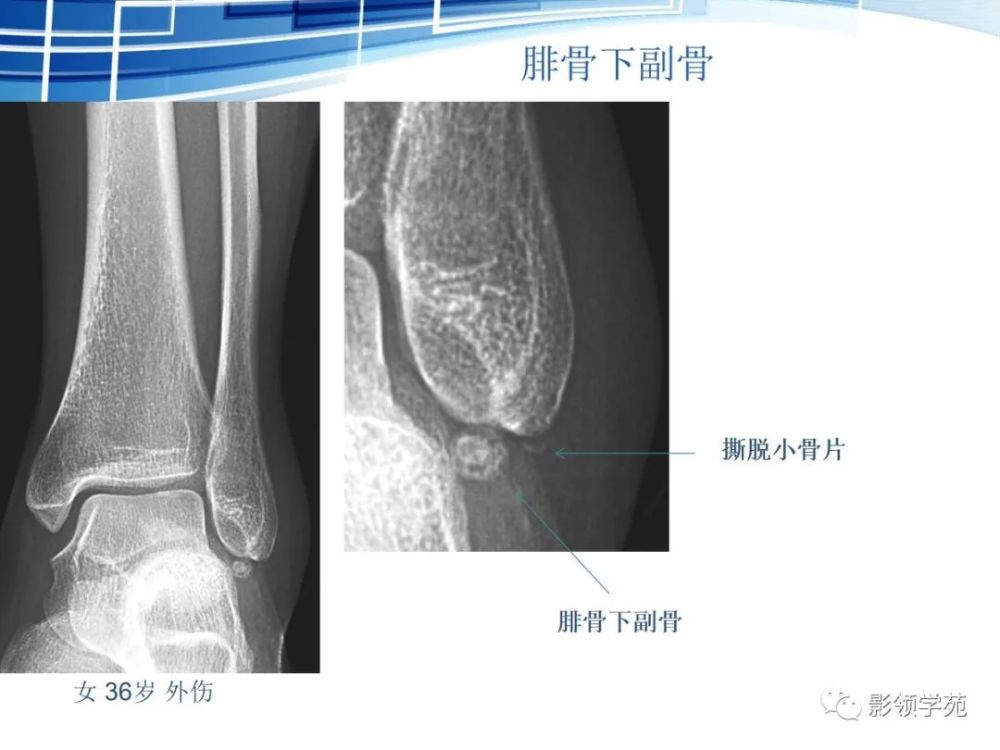 骨常见变异与撕脱骨折鉴别诊断