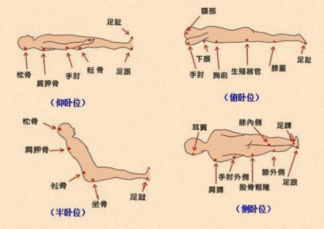 在侧卧位(侧躺)时,褥疮容易发生在耳廓,肩膀外侧,肋骨,髋骨(俗称"