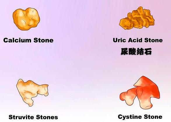 多喝水，就能把尿酸降至正常！真这么简单吗？医生辟谣给您讲清楚