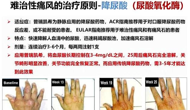 多喝水，就能把尿酸降至正常！真这么简单吗？医生辟谣给您讲清楚