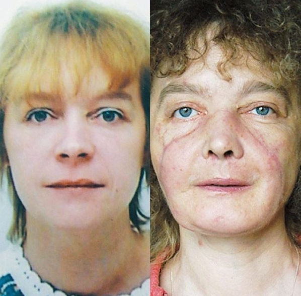 世界最长寿换脸女子去世，被丈夫崩了一枪，八成面部结构被替换