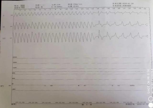 患者术中室颤和心跳停止时的心电图