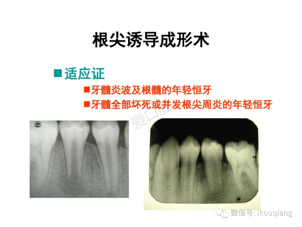 图解根尖诱导成形术