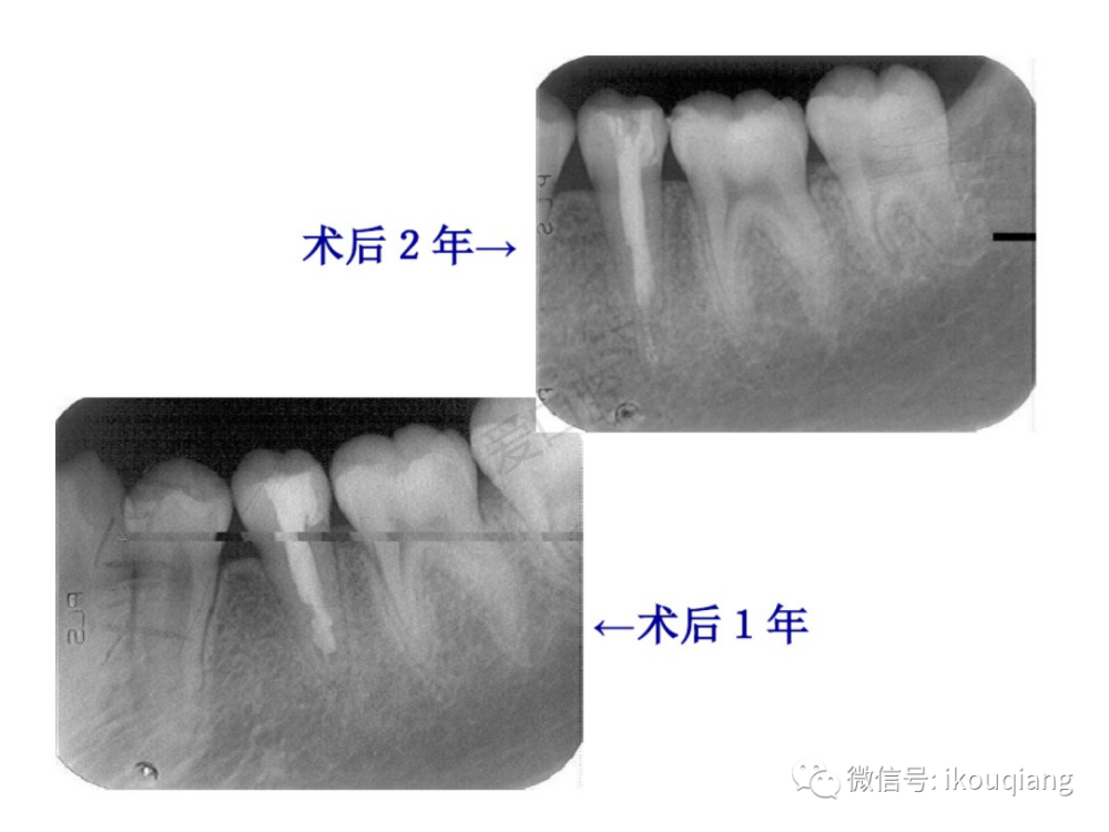 图解根尖诱导成形术