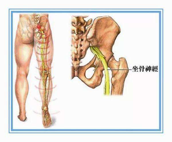 因为坐骨神经由腰4一骶3神经根组成,并沿梨状肌下孔出骨盆至臂大肌深