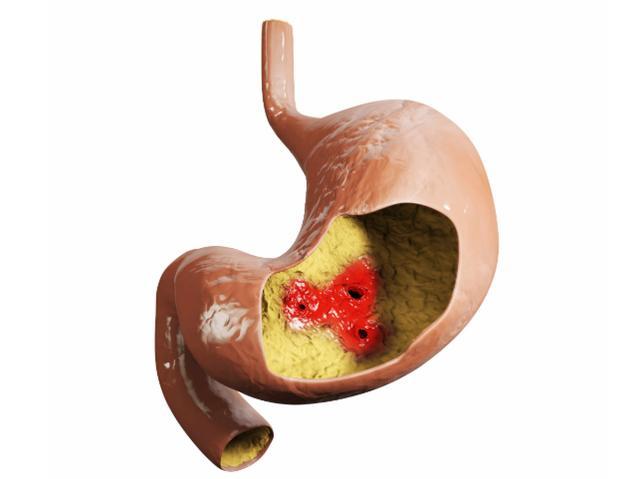 胃溃疡有5个癌变信号发现一个也别忽视及时就医治疗