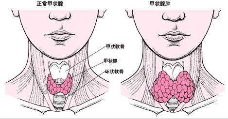 甲状腺肿,弥漫性甲状腺肿大?甲状腺肿早中晚期警惕这些不同症状