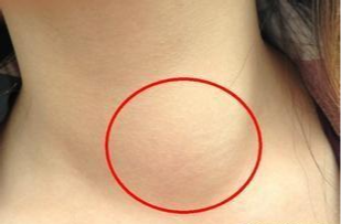 甲状腺肿大(中期Ⅱ) 症状: 1,颈部肿大明显 2,形成甲状腺结节 3,或