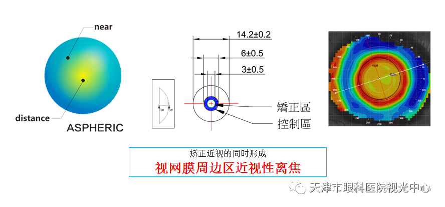 角膜接触镜聊聊多焦点软镜的那些事儿