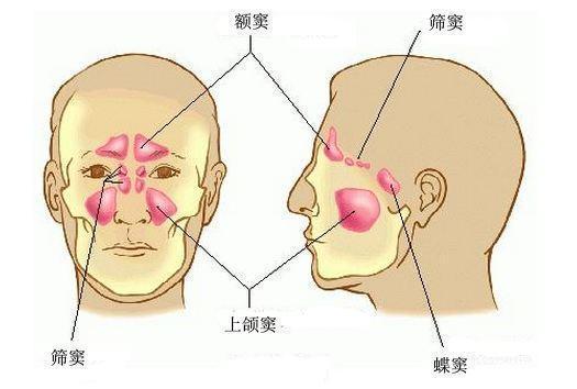 今天来分享一个鼻窦囊肿的病例,张女士因为头痛眼胀先去了大医院的