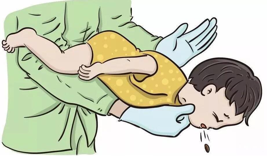 怀疑小儿气道异物,如何急救?_重庆中民耳鼻喉医院
