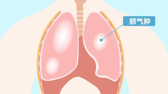 肺气肿该如何治疗?