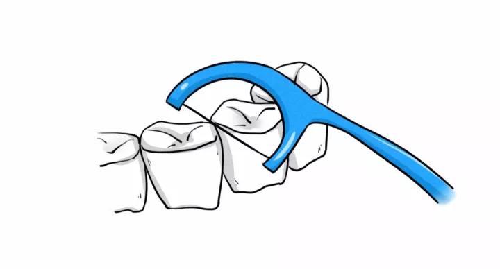 3使用牙线剔牙,不要用牙签 因为使用牙签会加重牙龈损伤