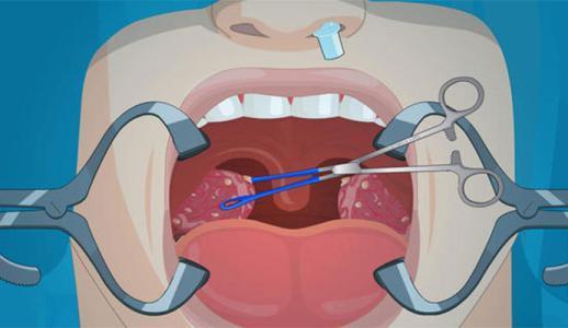 扁桃体炎的症状以及治疗