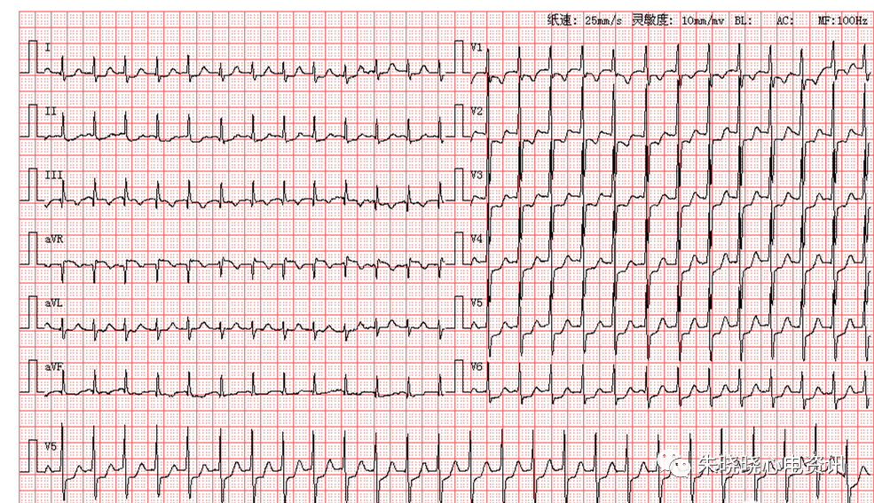 常见的室性心律失常心电图_腾讯新闻