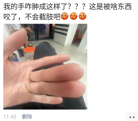 搞笑图片手肿成这样还能要么