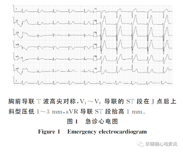 延误识别心电图de winter现象,致缺血性心肌病