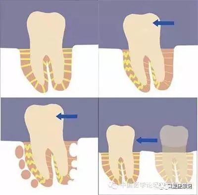 成都：牙齿矫正后复发的原因是什么？