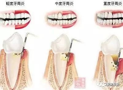 成都：牙齿矫正后复发的原因是什么？