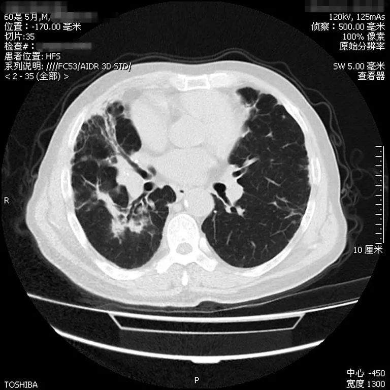 过敏性肺炎的ct