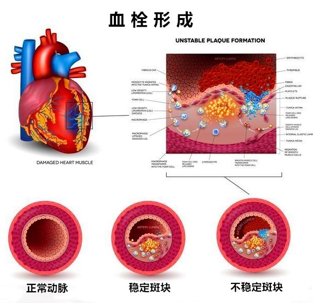 动脉血栓,静脉血栓都是血栓,可是成因不同,治疗也不一样