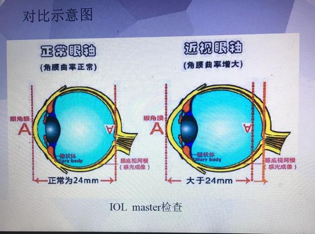 两者匹配, 在儿童生长发育过程中, 角膜曲率不会有很大变化, 而眼轴是